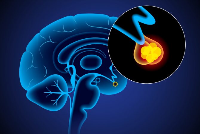 tumor hipofize