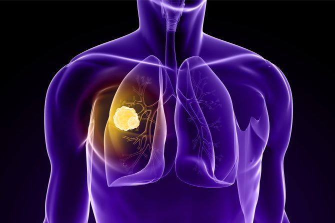rak pluća