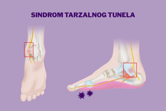 sindrom tarzalnog tunela
