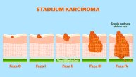 Stadijum karcinoma – šta nam govori faza u kojoj se rak nalazi