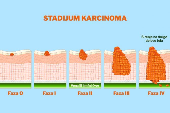 stadijum karcinoma