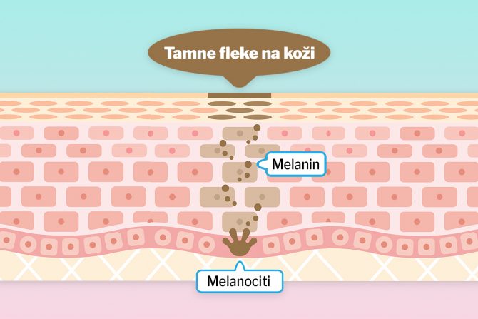 tamne fleke na koži
