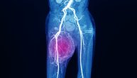 Angiogram pokazuje stanje arterija i vena – šta se radi tokom procedure i kako se pripremiti