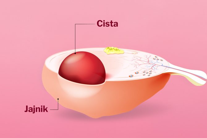 ciste na jajnicima