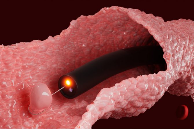 polip na debelom crevu