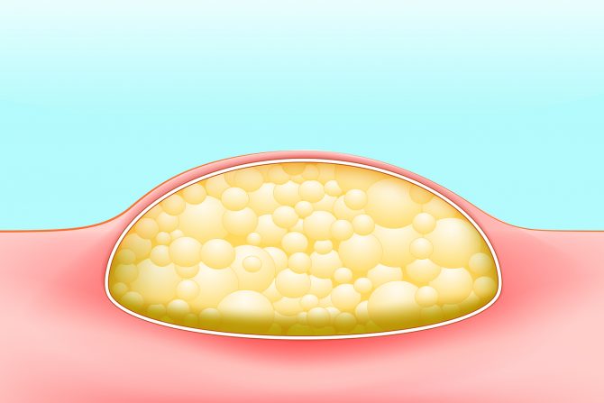 kvržice i izrasline na telu