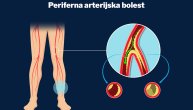 Na koji način bolest perifernih arterija ugrožava srce i mozak