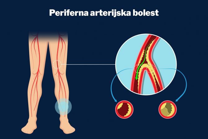 bolest perifernih arterija