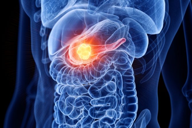 rak pankreasa