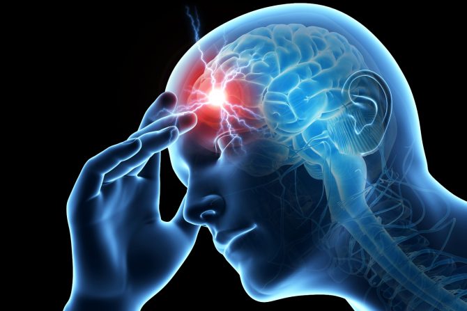 rizik od moždanog udara