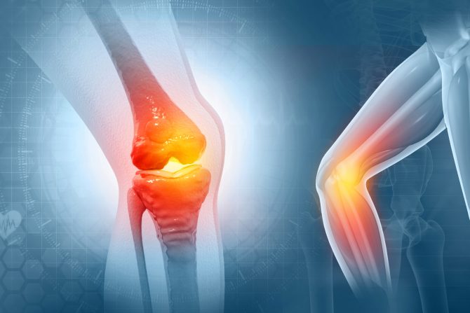 ishrana kod artritisa