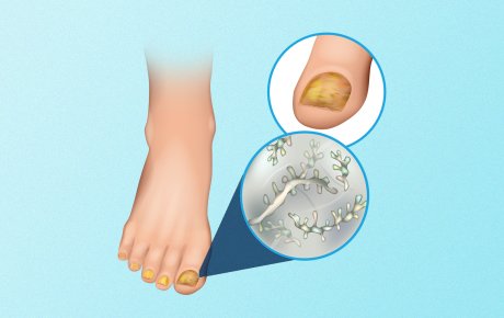 gljivična infekcija noktiju