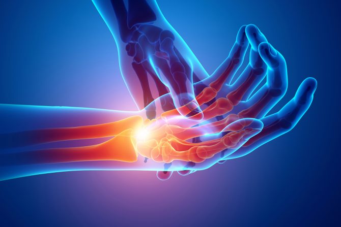 Sindrom karpalnog tunela