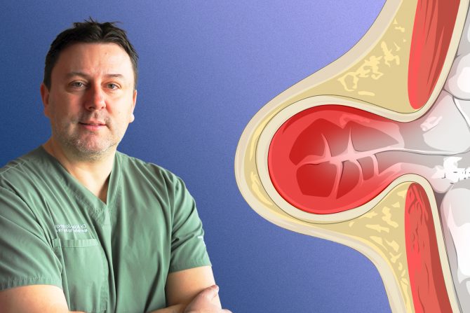 Preponska kila, dr Bojan Jovanović