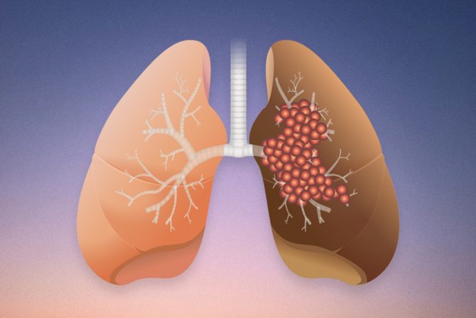 rak pluća