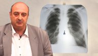 Ljudi gutaju razne stvari, od kostiju do eksera i prstenja: Kada se obratiti lekaru