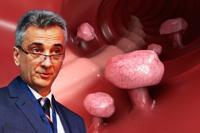 Polipi na debelom crevu, dr Miloš Bjelović