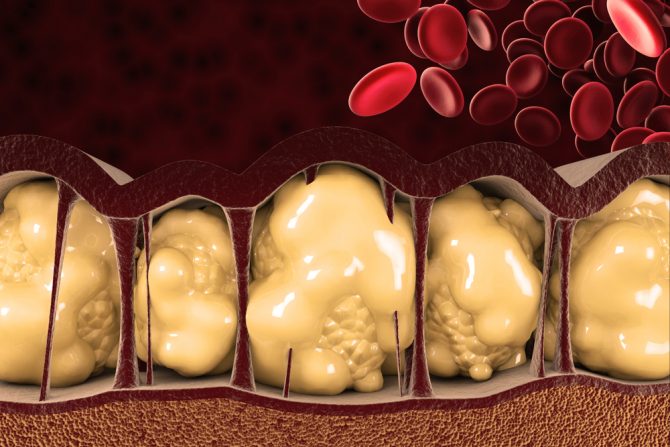 masne naslage na stomaku