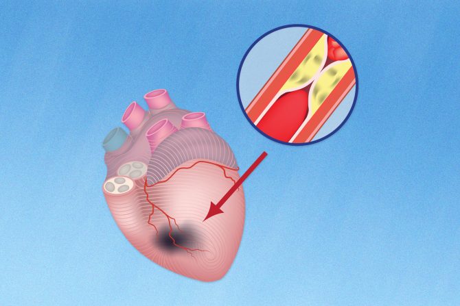 Rizik od srčane smrti