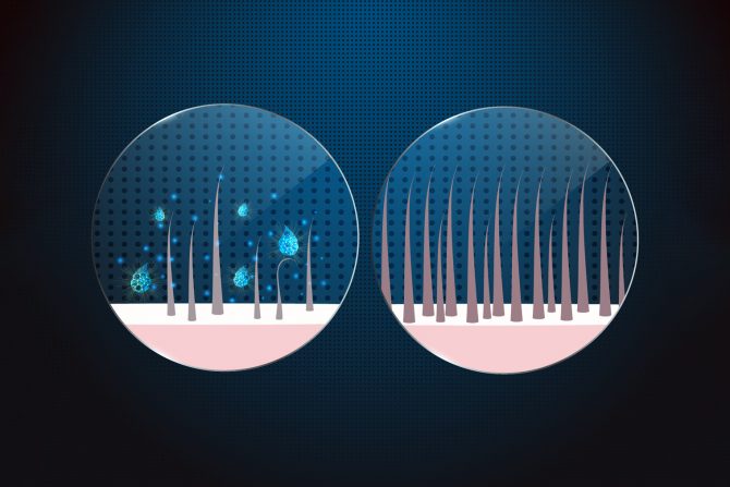 Hipotermija vlasišta