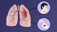 Hemoptizija je iskašljavanje krvi – šta znači i koliko je ozbiljna