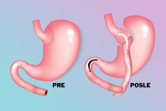Smanjenje telesne težine