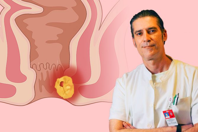 rak anusa dr Zoran Milenković