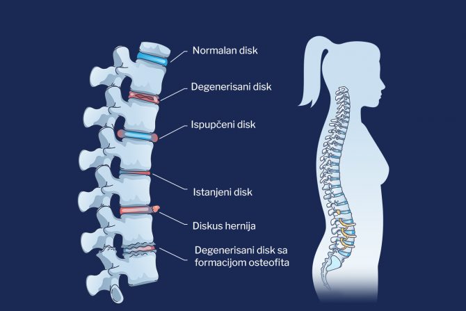 degenerativna bolest diska