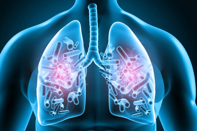 smrtonosne infekcije pluća