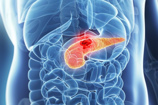rak pankreasa