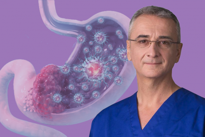 Difuzni karcinom želuca dr Miloš Bjelović