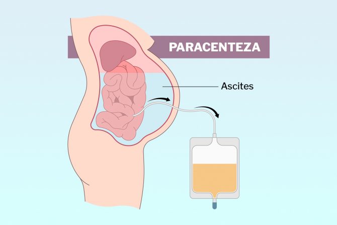 paracenteza