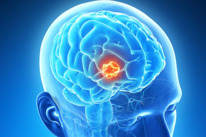 smrtonosni rak mozga