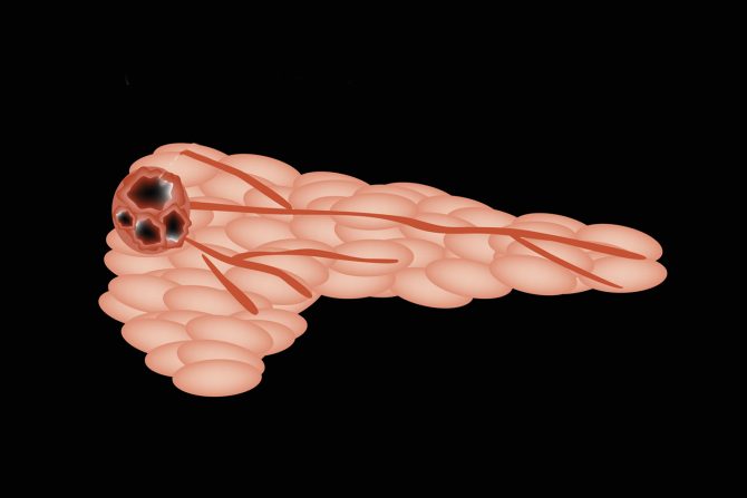 Najsmrtonosniji rak pankreasa