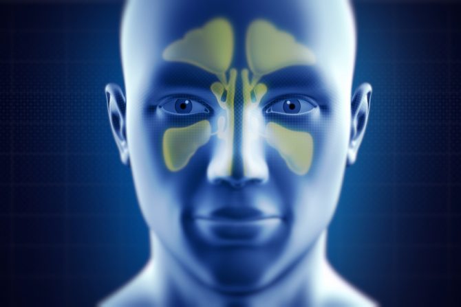 sinusitis