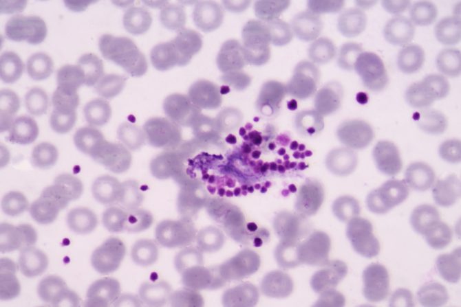 Pseudotrombocitopenija