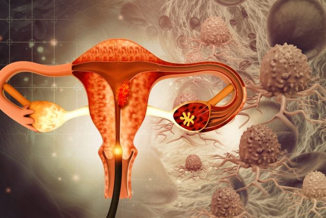 rak grlića materice