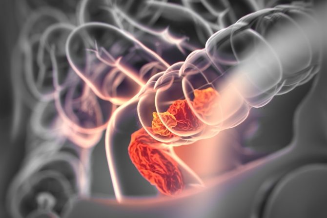 kolorektalni karcinom