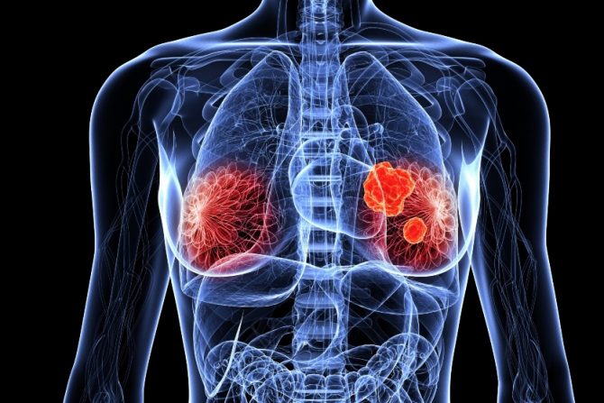 operacija raka dojke