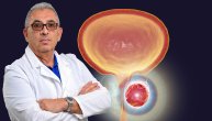 Rak prostate se leči dobrom dijagnostikom, hemijski kastratori čuvaju testise muškaraca
