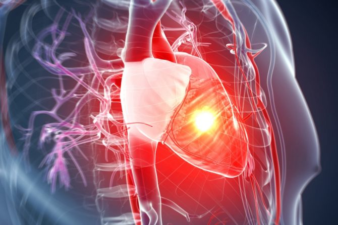 oporavak od srčanog udara