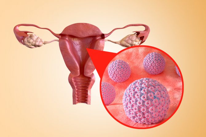 rak grlića materice