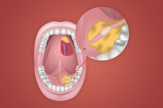 kamen u pljuvačnoj žlezdi