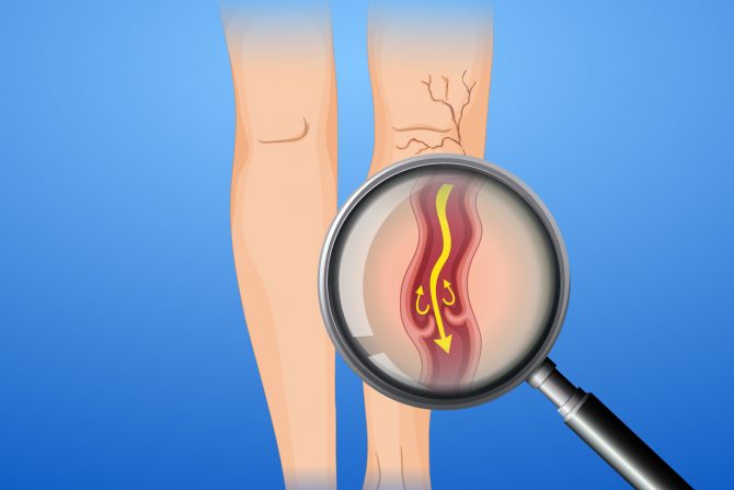 duboka venska tromboza