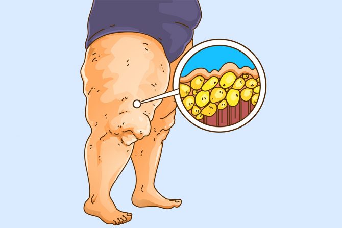 lipoedem debele noge