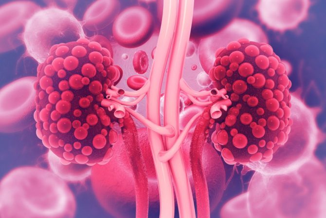 policistični bubrezi