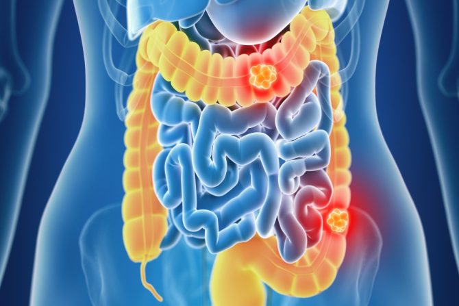 Hematohezija rak creva