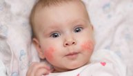 Atopijski dermatitis – veza između ishrane i kožnih bolesti