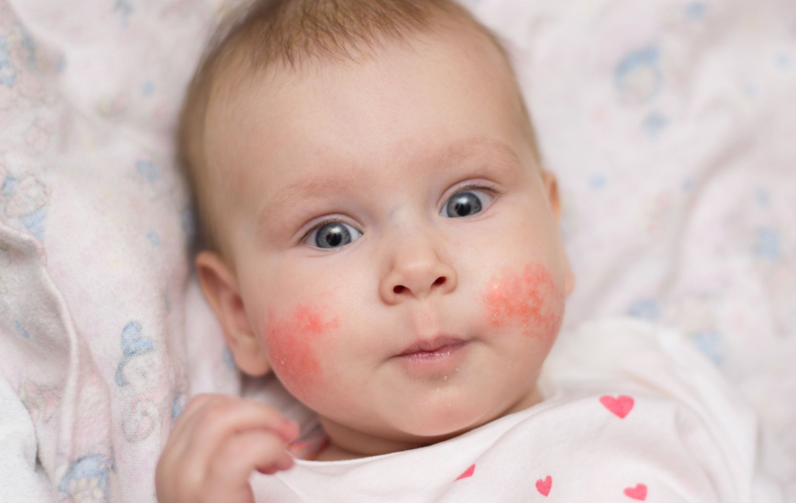 Atopijski dermatitis  veza izmeu ishrane i konih bolesti - eKlinika