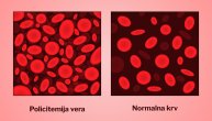Maligna bolest policitemija vera na slikovit način predstavljena uz pomoć instalacije